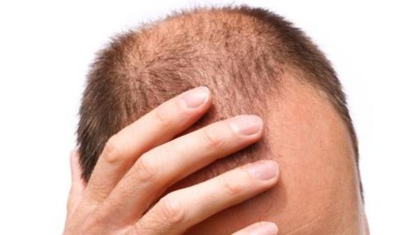 للرجال فقط.. 12 سبباً مدهشاً للصلع