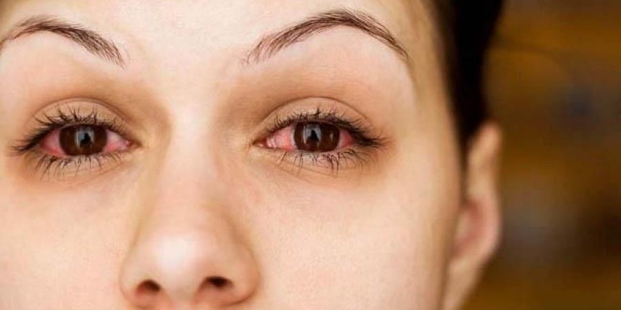 7 أسباب لاحمرار العينين يجب أن تعرفها