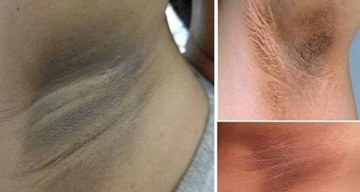 إليكم هذه الطريقة السحرية للتخلص من سواد الإبطين!