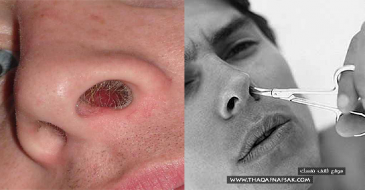 اذا قمت بازالة شعر الانف لمرة واحدة .. هكذا ستكون نهاية الامر!