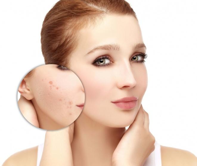 5 طرق سهلة لاستخدام العسل والتخلص من حب الشباب