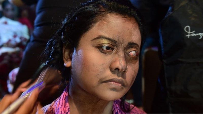 (فيديو) في يوم المرأة… بنغلاديش تنظم عرض أزياء لضحايا هجوم حمض الاسيد
