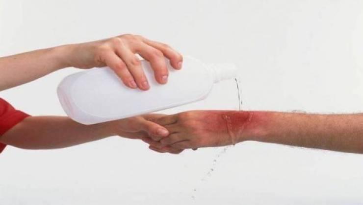 عشبة موجودة بكلّ منزل تخلّصكم من آثار الحروق بـ10 دقائق!