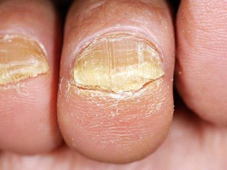 طرق معالجة فطريات الأظافر والوقاية منها