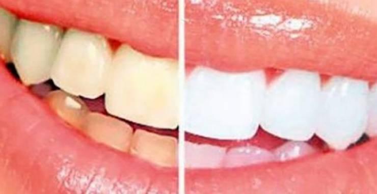 هكذا تتخلصون من اصفرار الأسنان في المنزل