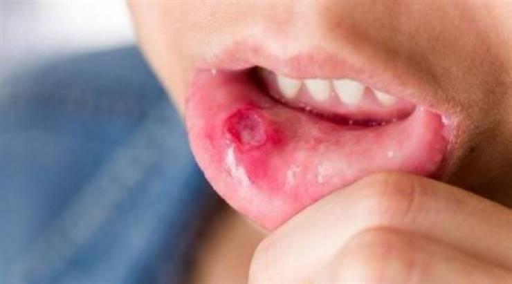تدابير صحية ضرورية لمرضى فيروس الهربس