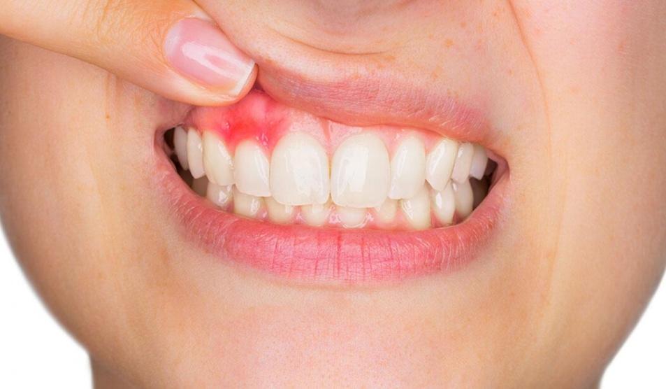 ما علاقة أمراض اللثة بالتهاب المفاصل؟