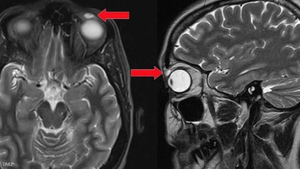 عاشت 30 عاما بشيء غير مريح في عينها.. ثم جاءت 