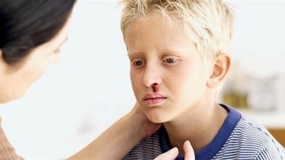 نزيف الأنف لدى الأطفال