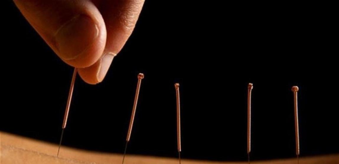 معالج يثقب رئتي مريضة خلال علاجها بالوخز بالإبر