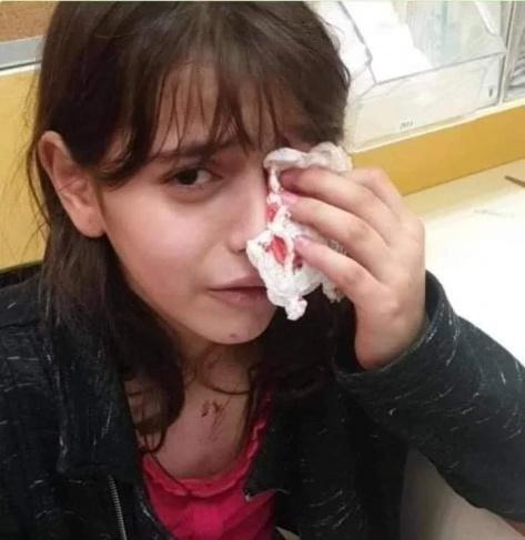 مستوطن يعتدي على طفلة ويصيبها بجروح في عينها