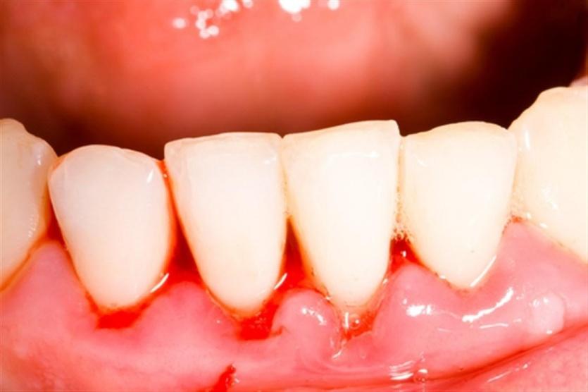 مصابو التهاب اللثة معرضون للمضاعفات الخطيرة لفيروس كورونا