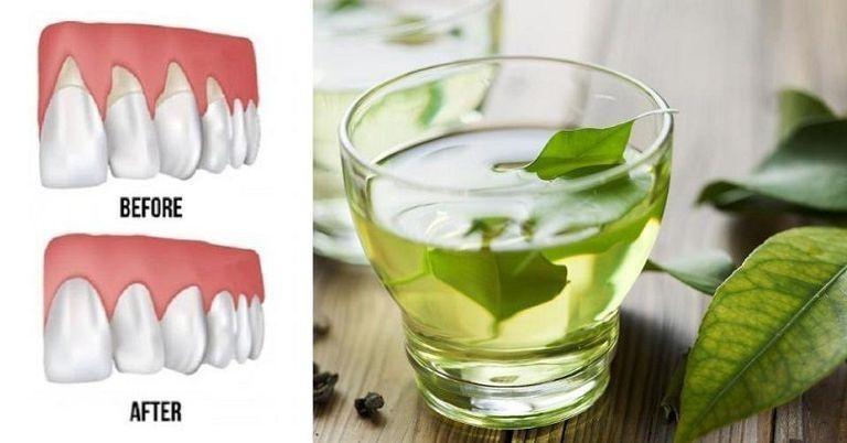 علاجات طبيعية لالتهاب اللثة بالمنزل