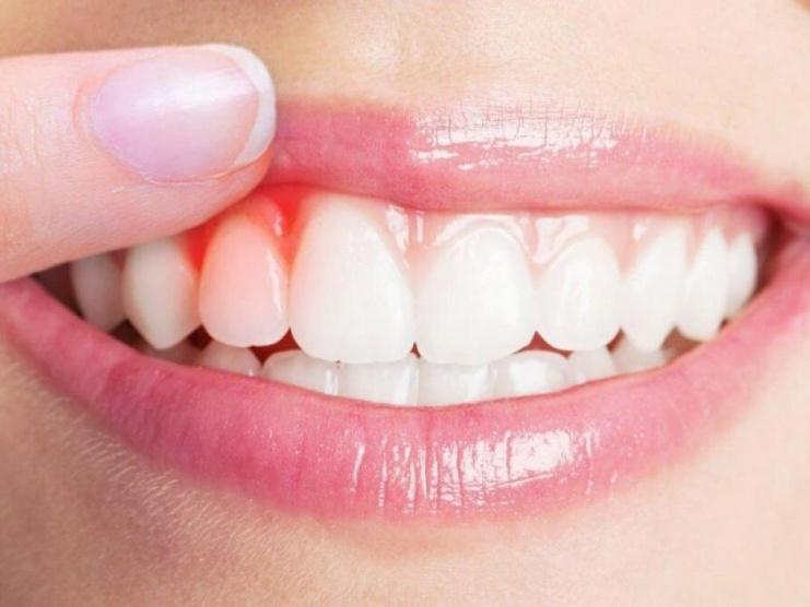كيف يؤثر التهاب اللثة على الدماغ وهل يسبب الزهايمر؟