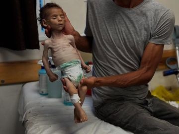 في غضون 24 ساعة: وفاة 7 مواطنين بسبب المجاعة وسوء التغذية في قطاع غزة