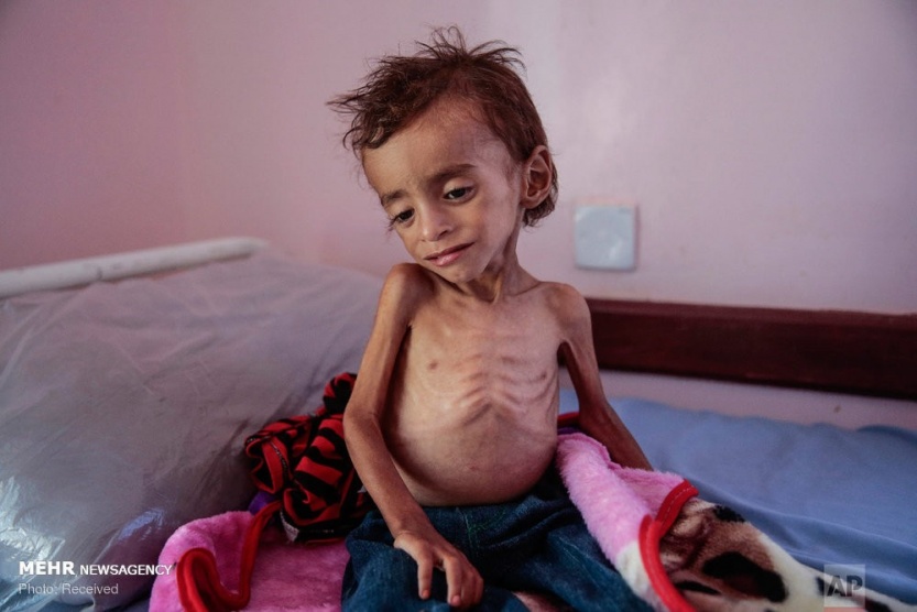 وفاة 4 مواطنين خلال الـ24 ساعة الماضية بسبب سوء التغذية والمجاعة في قطاع غزة