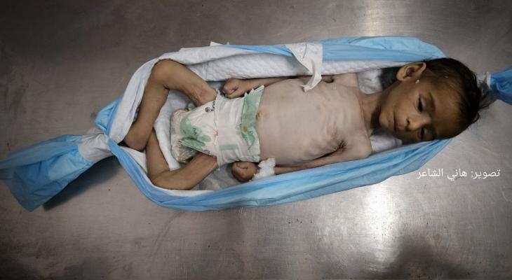 4 مواطنين جدد يفارقون الحياة جوعًا في غزة