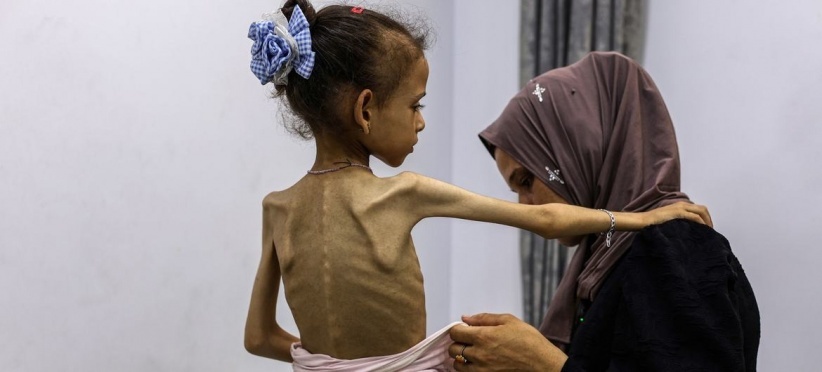 3 وفيات نتيجة التجويع بغزة خلال يوم لترتفع الحصيلة لـ 428