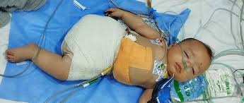 15 ألف مبتور أطرافهم واحتياجات طبية عاجلة في غزة